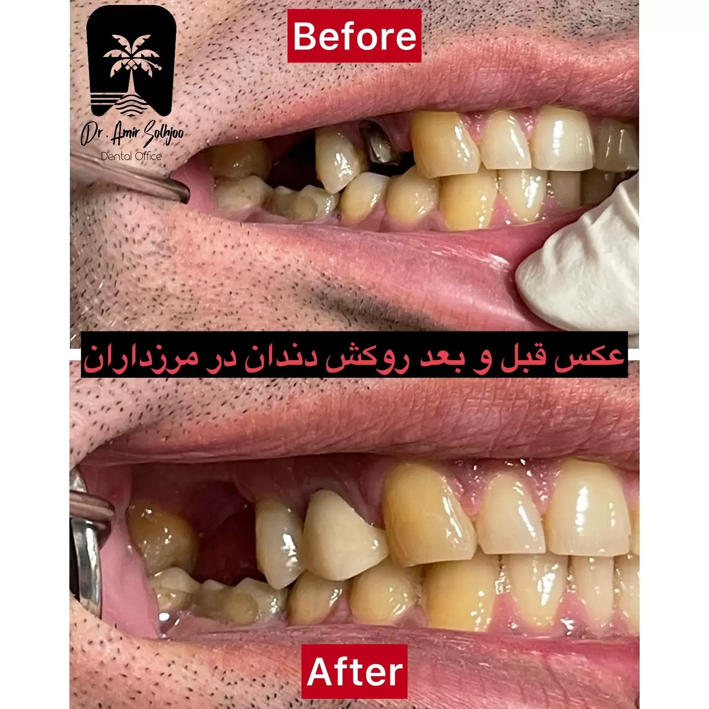 قالب گیری دندان در تهران