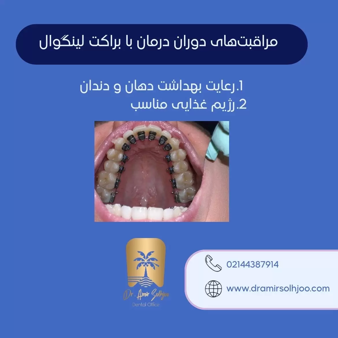 براکت لینگوال