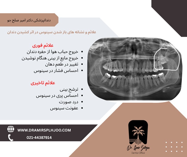 باز شدن سینوس در اثر کشیدن دندان