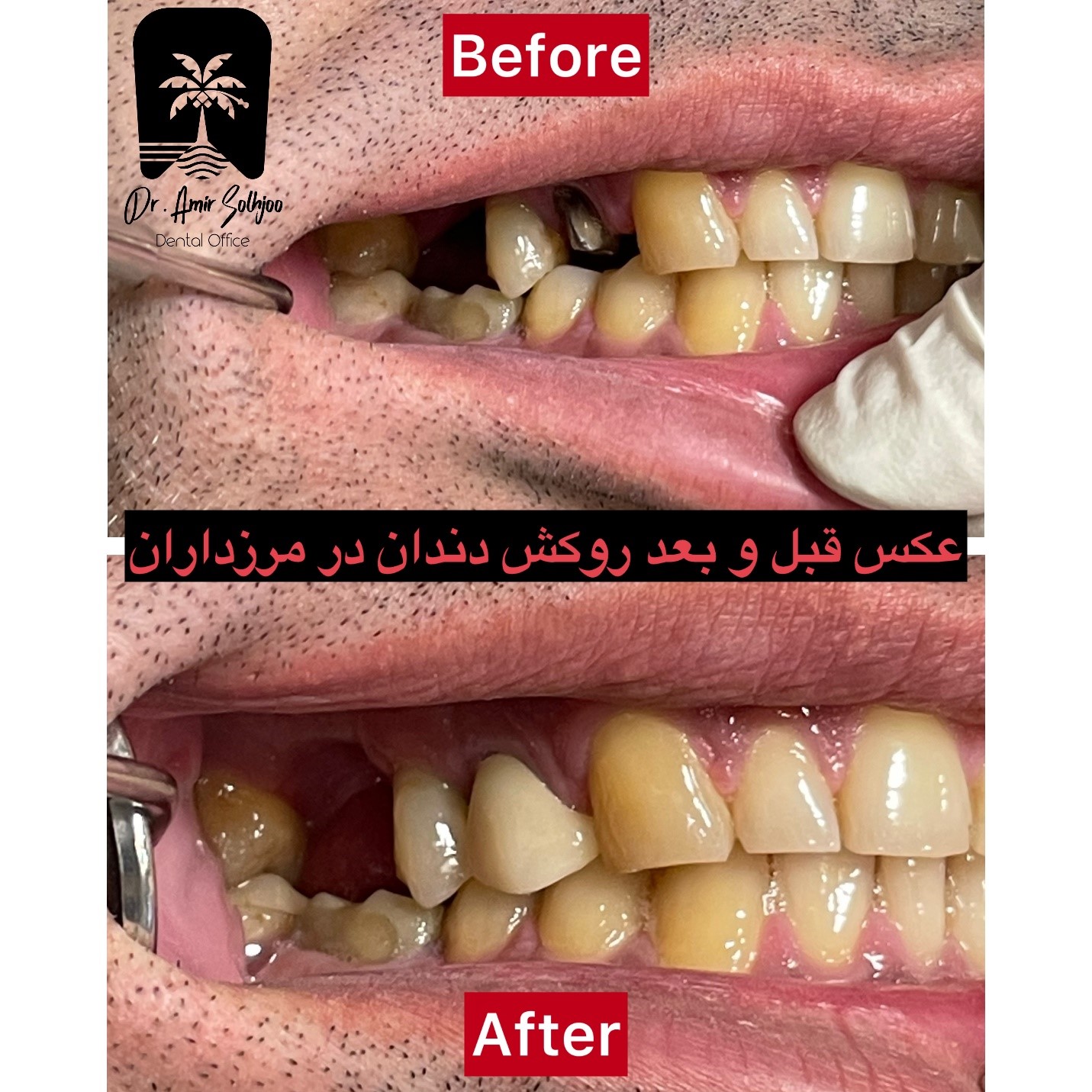 قیمت روکش سرامیکی دندان