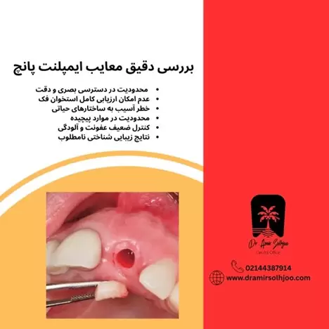 معایب ایمپلنت پانچ