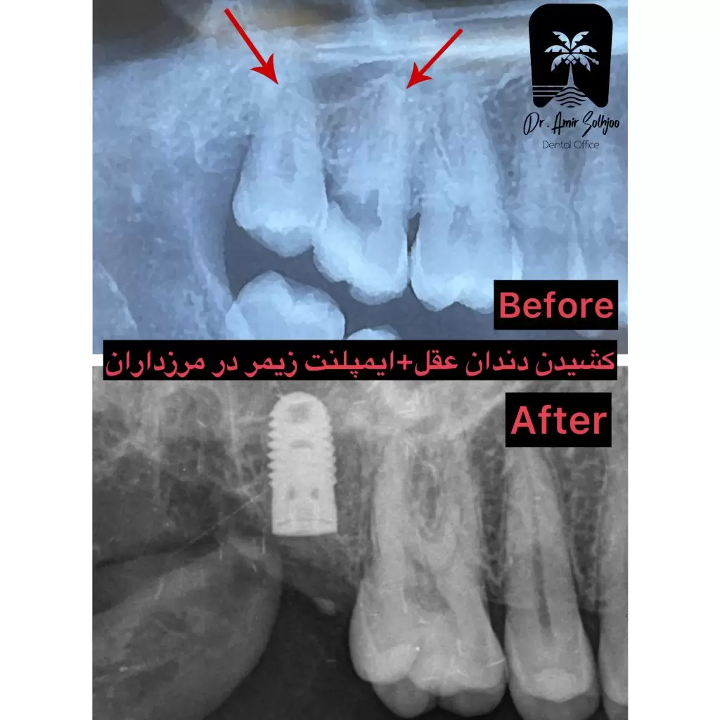 هزینه ایمپلنت در غرب تهران