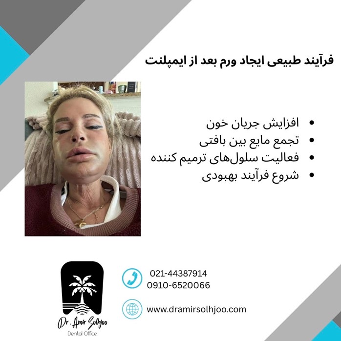 فرآیند طبیعی ایجاد ورم بعد از ایمپلنت