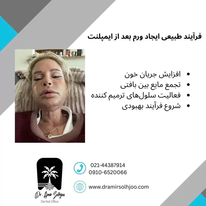 فرآیند طبیعی ایجاد ورم بعد از ایمپلنت
