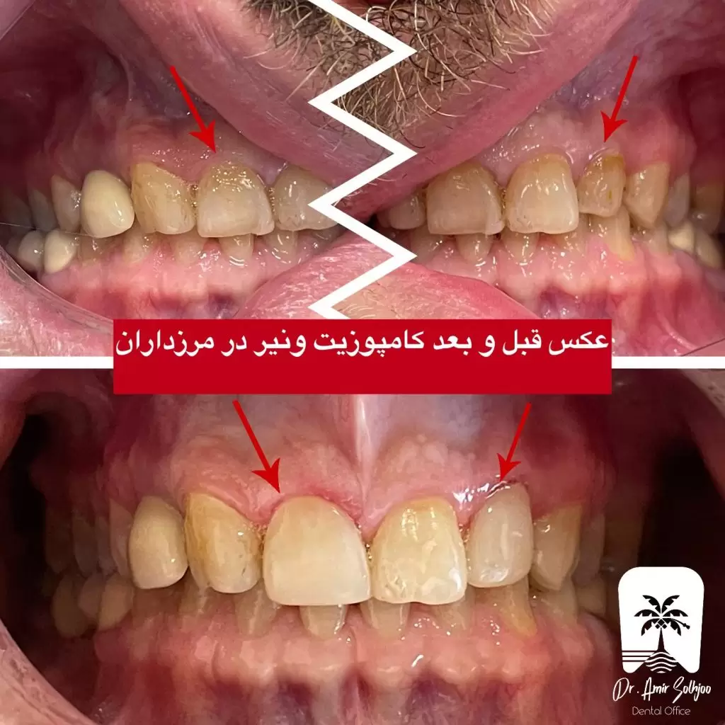 ترمیم دندان با کامپوزیت در غرب تهران