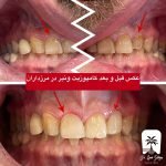 ترمیم دندان با کامپوزیت در غرب تهران