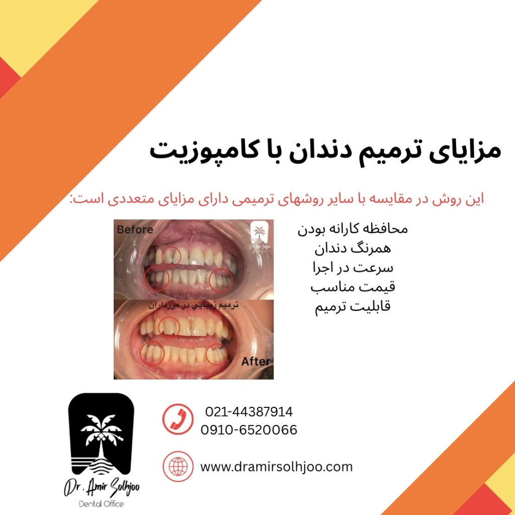 ترمیم دندان با کامپوزیت