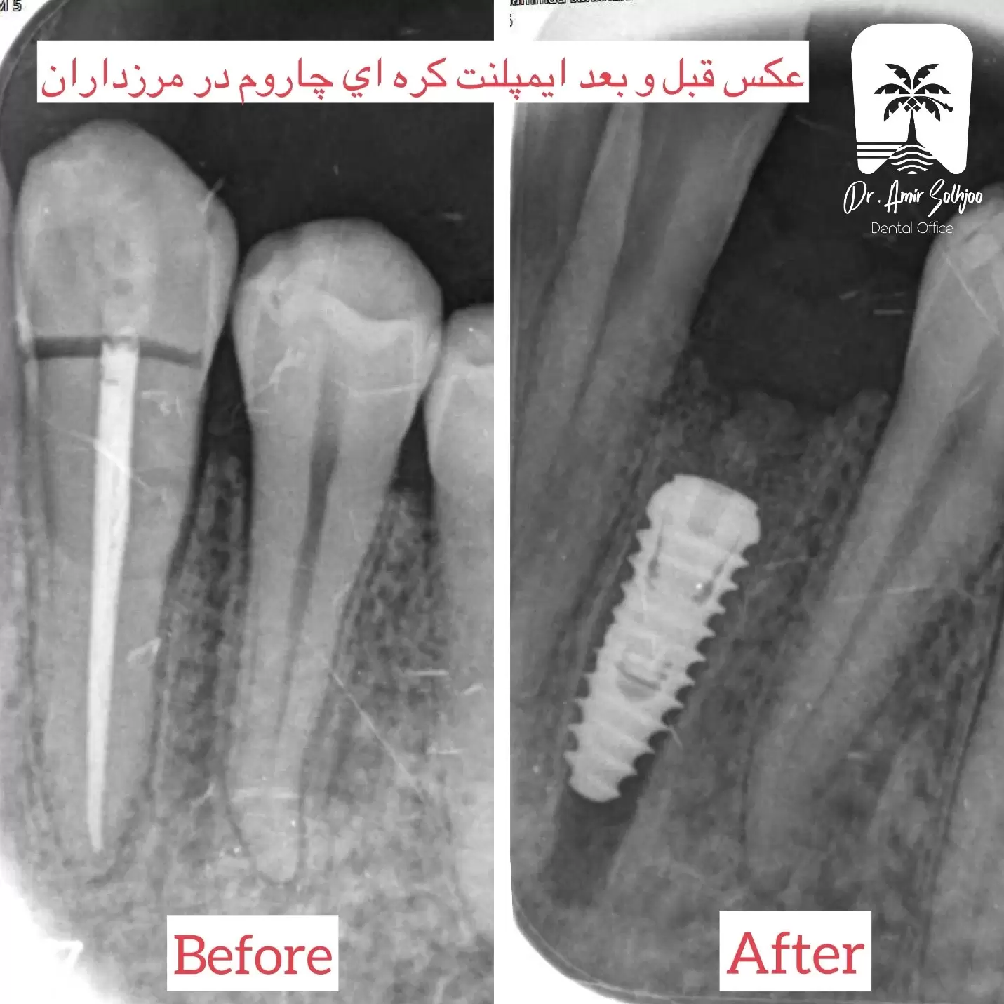 قیمت ایمپلنت در غرب تهران