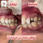 قالب گیری دندان برای روکش