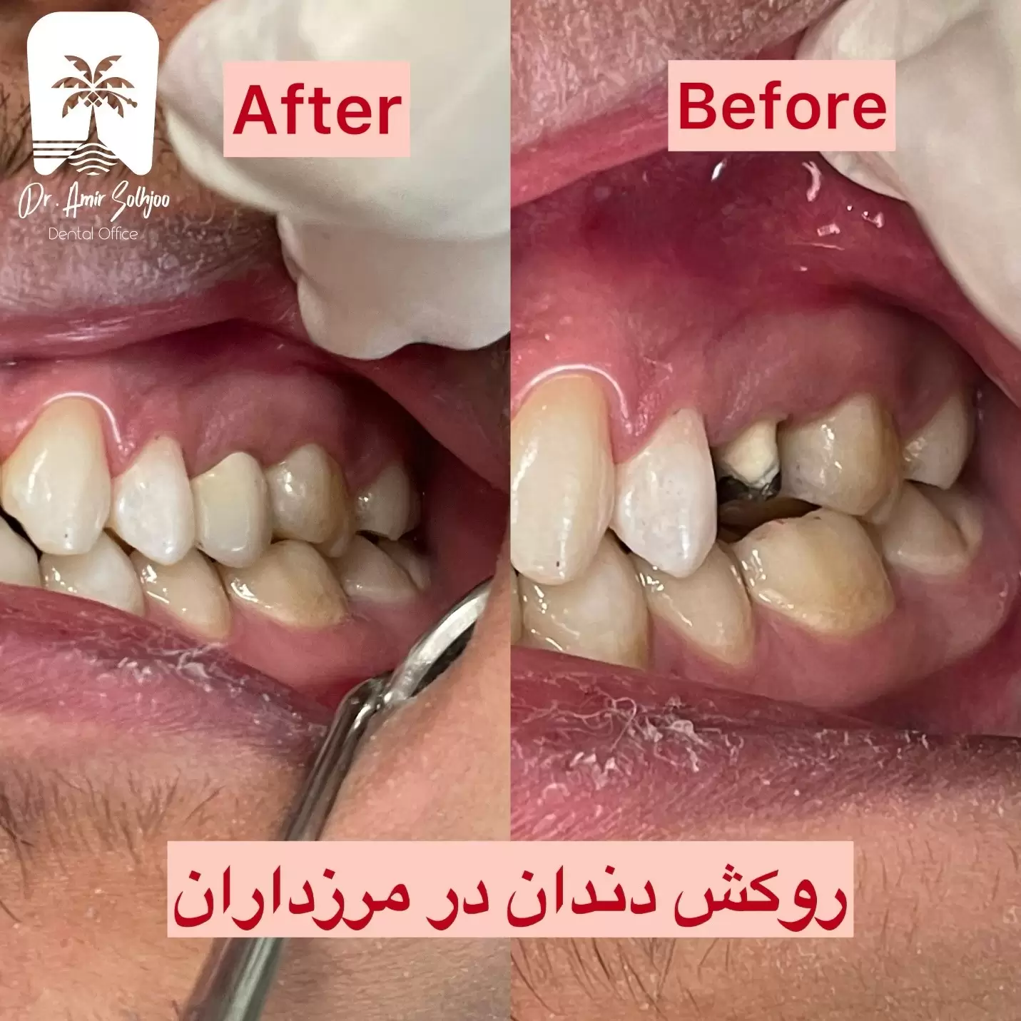 قالب گیری دندان برای روکش