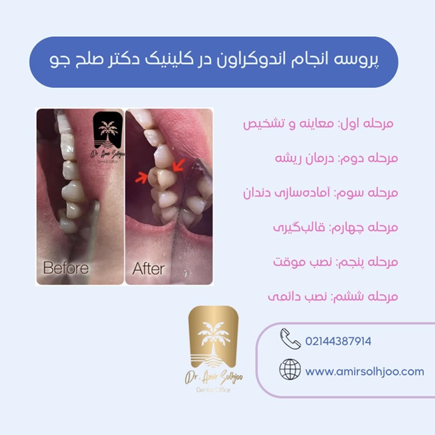هزینه اندوکراون در مرزداران