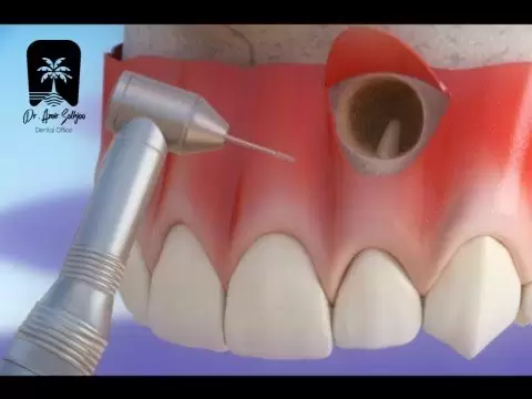 آپیکواکتومی