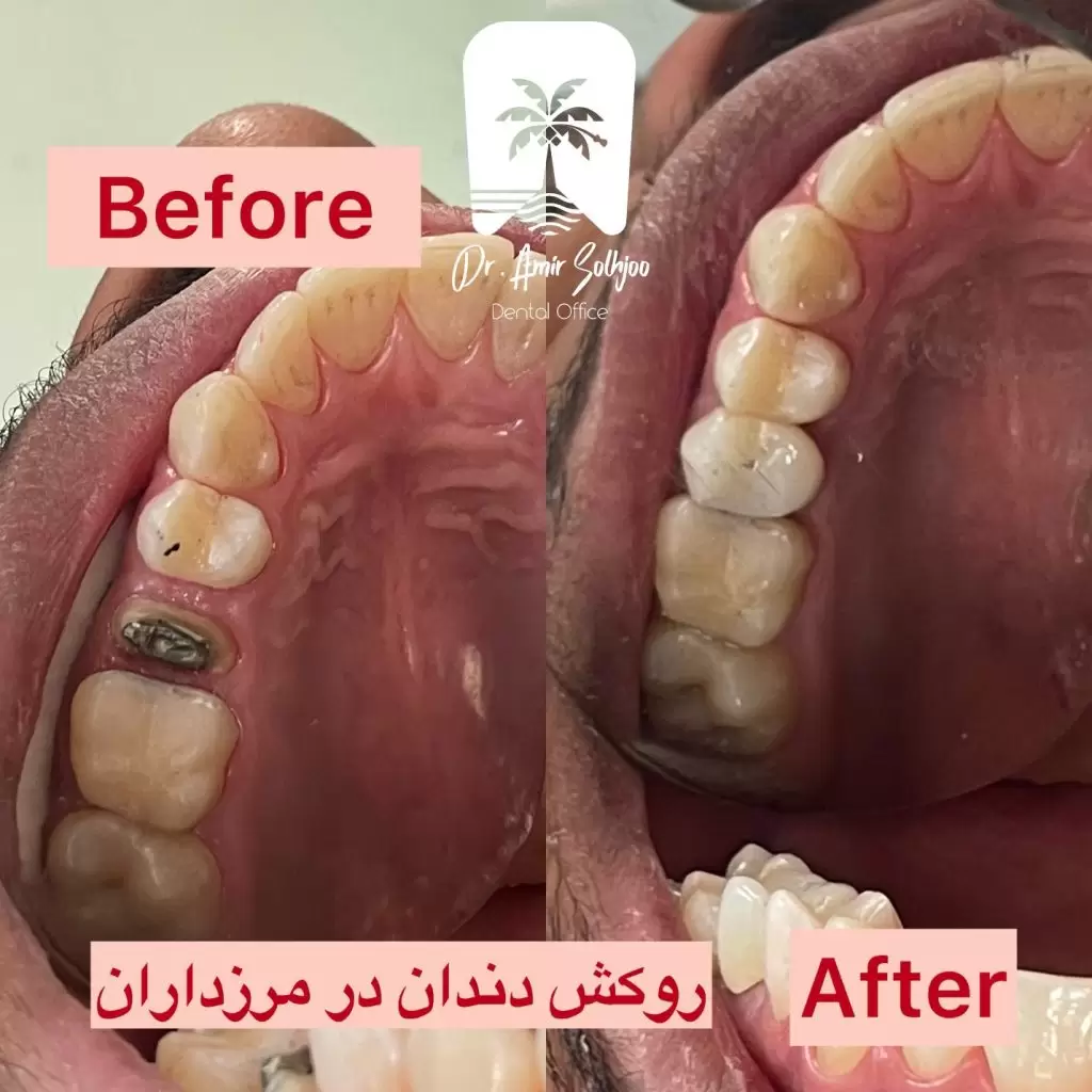 عکس قبل و بعد روکش دندان