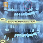 جراحی نیش نهفته در مرزداران