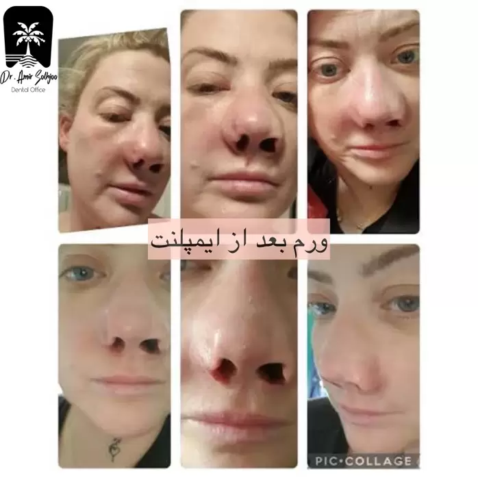 ورم بعد از ایمپلنت