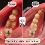 هزینه اندوکراون در مرزداران