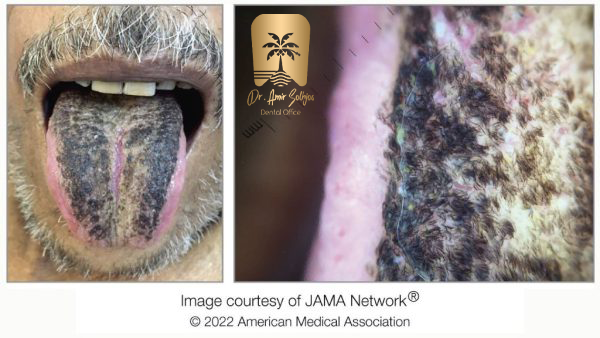 علائم زبان مودار سیاه