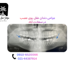 جراحی دندان عقل روی عصب در سعادت آباد