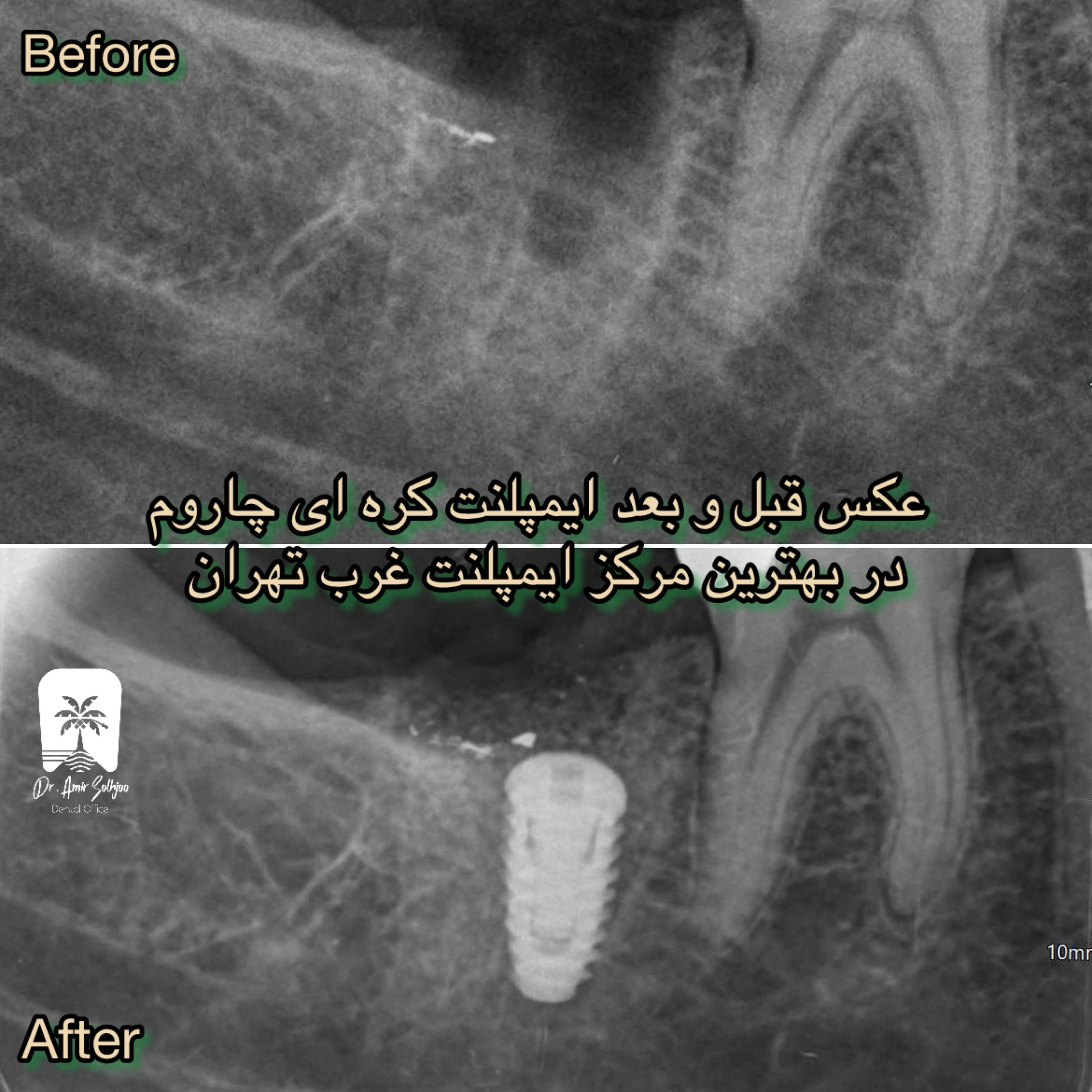 ایمپلنت دندان در شهرک غرب