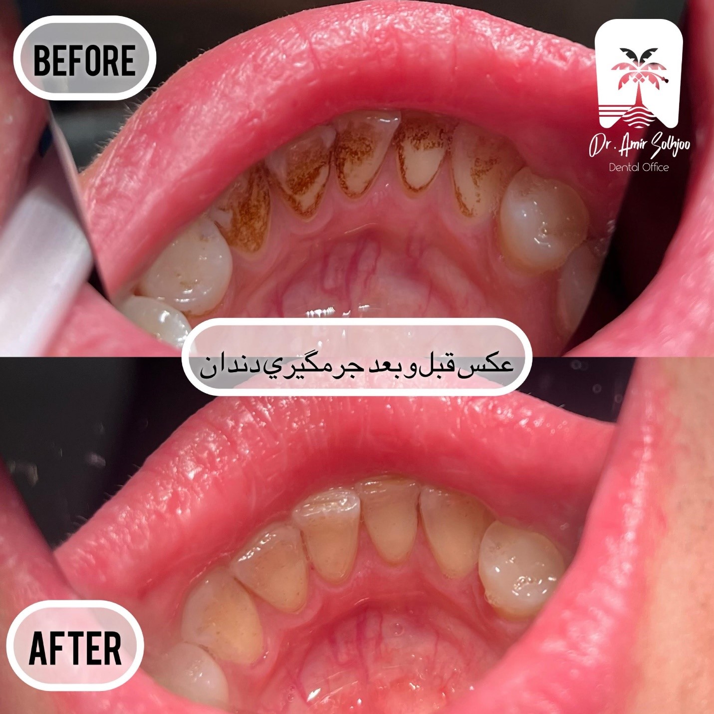 جرمگیری دندان در باغ فیض