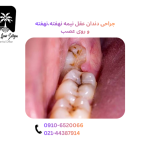 جراحی دندان عقل نیمه نهفته، نهفته و روی عصب