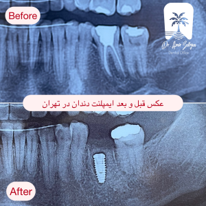 دندانپزشکی ایمپلنت دندان در کرج