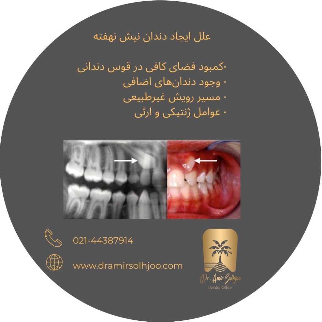 جراحی نیش نهفته در شهرک غرب