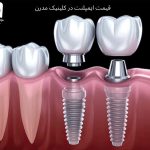 قیمت ایمپلنت در کلینیک مدرن