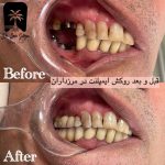 قبل و بعد روکش ایمپلنت در مرزداران
