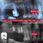 بهترین دکتر ایمپلنت در مرزداران