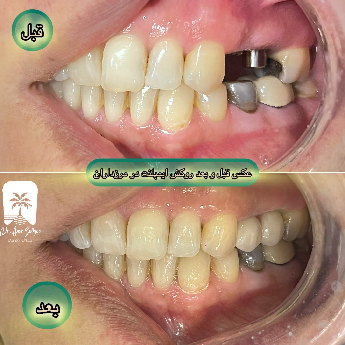 بهترین دکتر ایمپلنت در غرب تهران