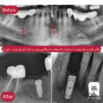 بهترین متخصص ایمپلنت در ایران