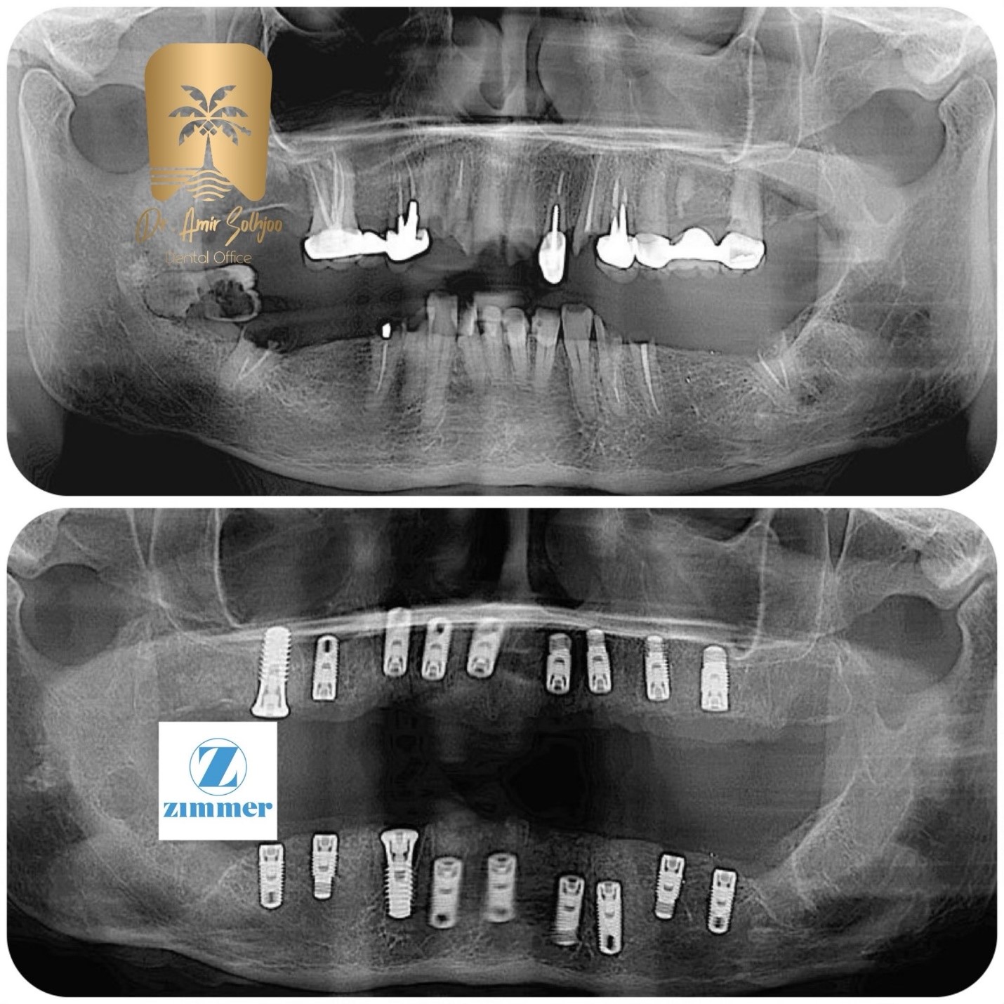قیمت فول ایمپلنت