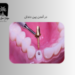 درآمدن پین دندان
