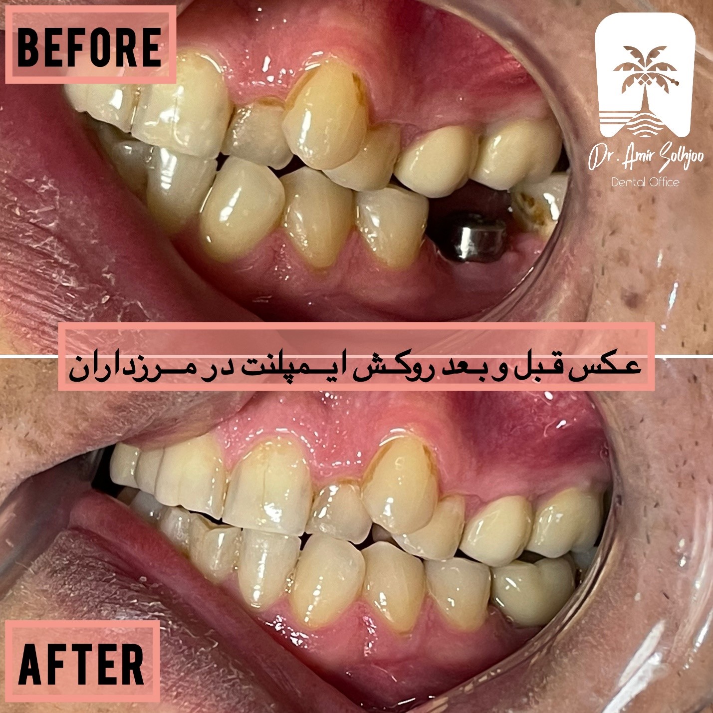 بهترین ايمپلنتولوژیست ایران