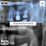بهترین مرکز ایمپلنت ایران: راهنمای انتخاب مرکزی معتبر برای لبخندی ماندگار
