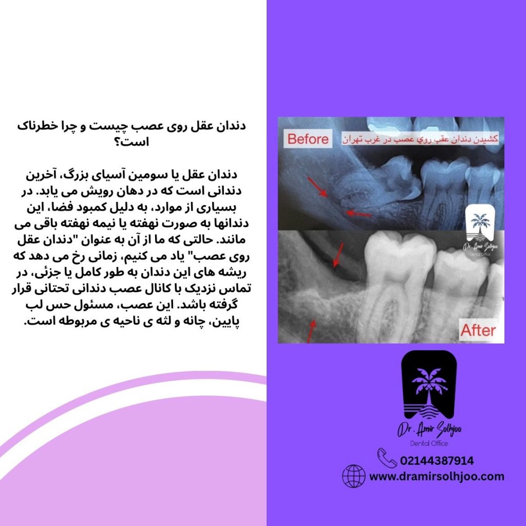 جراحی دندان عقل روی عصب در شهرک غرب