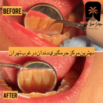 جرمگیری دندان در آیت الله کاشانی