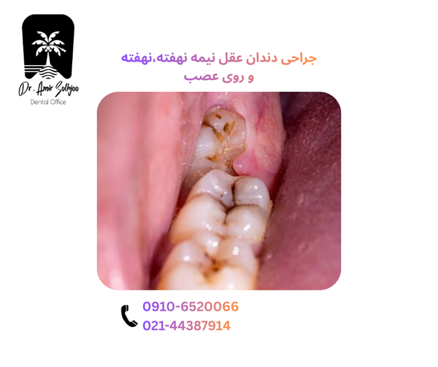 جراحی دندان عقل نیمه نهفته، نهفته و روی عصب