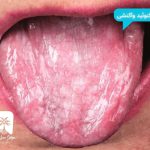 لیکنوئید واکنشی