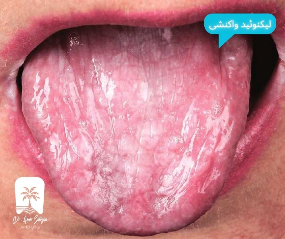 لیکنوئید واکنشی