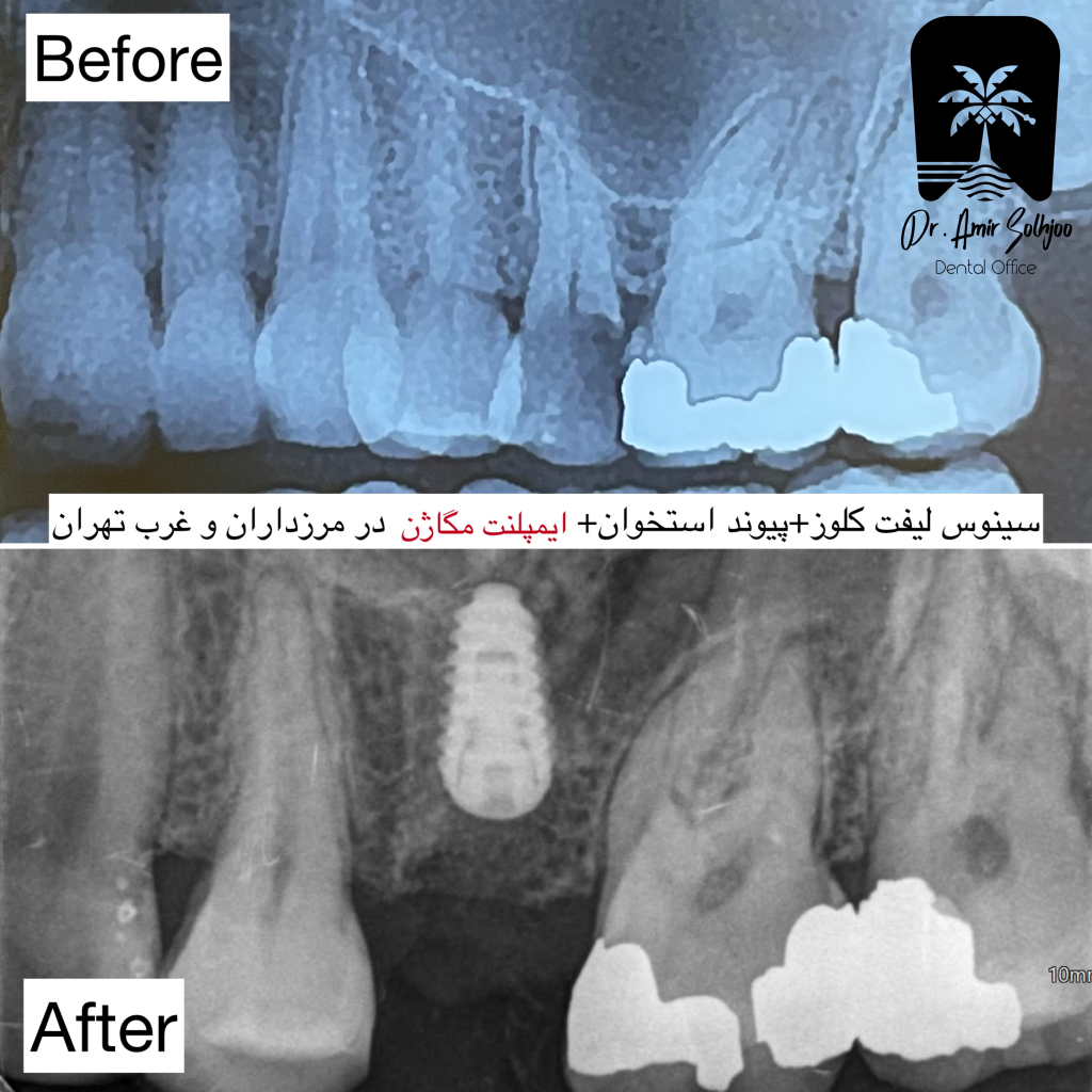 ایمپلنت کره ای مگاژن