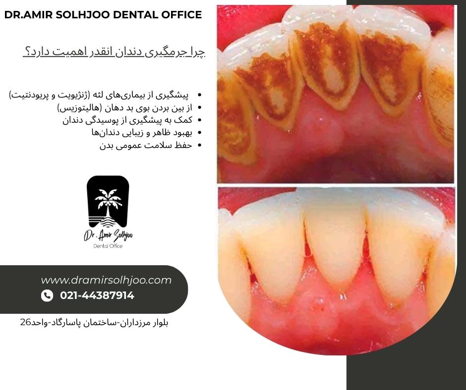 جرمگیری دندان در باغ فیض