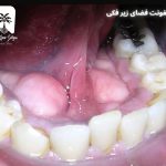 عفونت های فضای زیر فکی