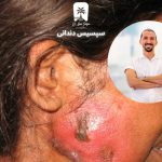 سپسیس