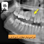 جراحی نیش نهفته در شهرک غرب