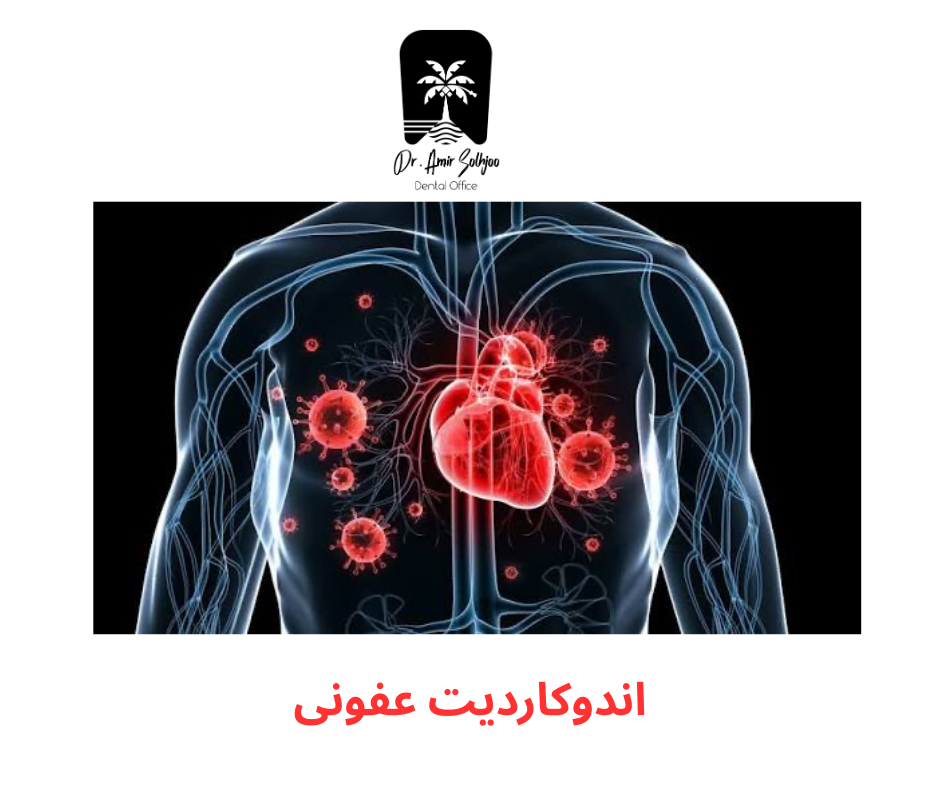 آندوکاردیت عفونی