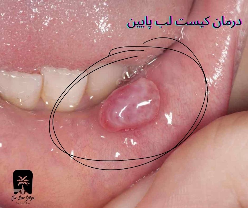 درمان کیست لب پایین