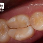 شکستگی های دندانی و فکی
