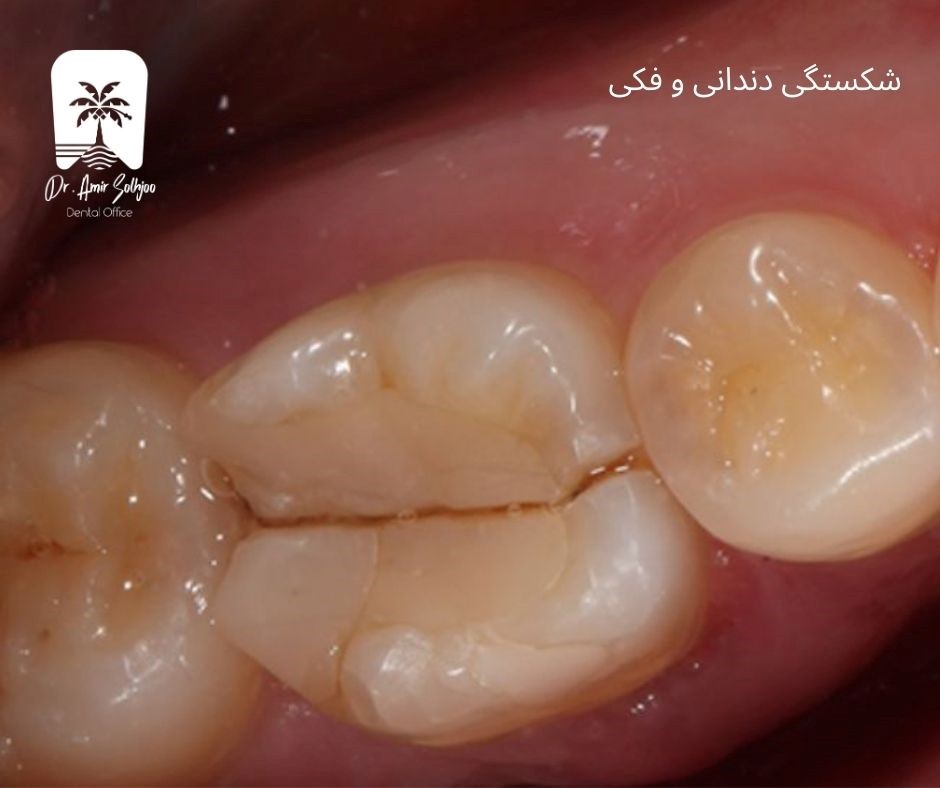 شکستگی های دندانی و فکی